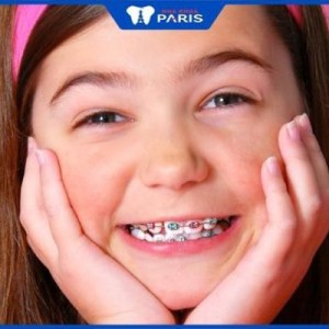 Niềng răng cho trẻ em có đau không? Lý do nên niềng răng cho bé