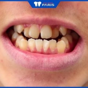 Niềng răng khểnh có phải nhổ răng không – Vị trí răng cần nhổ