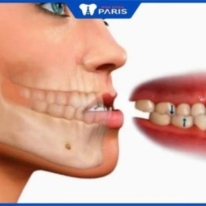 Niềng răng móm có đau không – 4 Cách niềng răng móm phổ biến