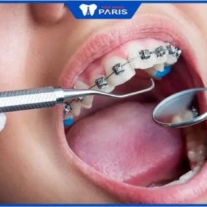 Niềng răng móm có phải nhổ răng không: 3 Trường hợp cụ thể