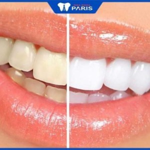 Tẩy trắng răng có an toàn không, cách chăm sóc sau khi tẩy răng