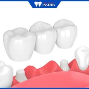 Trồng răng bắc cầu có tốt không – 5 phương pháp phổ biến