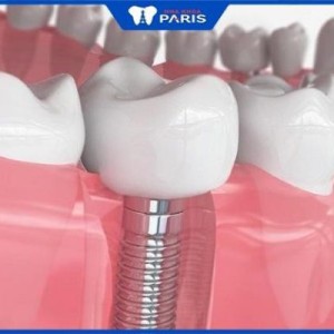 Trồng răng hàm mất bao nhiêu thời gian – Các yếu tố ảnh hưởng