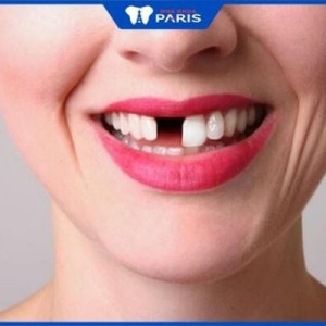 Có nên trồng răng giả không – 3 Phương pháp trồng răng phổ biến