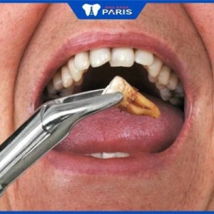 Nhổ răng hàm có ảnh hưởng gì không, 4 biến chứng có thể xảy ra