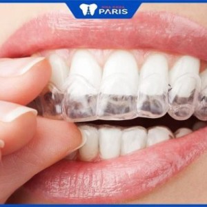 Niềng răng không mắc cài – phương pháp hiệu quả, thẩm mỹ cao