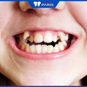 Răng khểnh có nên niềng không, 3 phương pháp niềng phổ biến