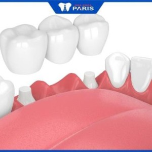 Trồng răng bắc cầu mất bao lâu – 5 ưu điểm nổi bật