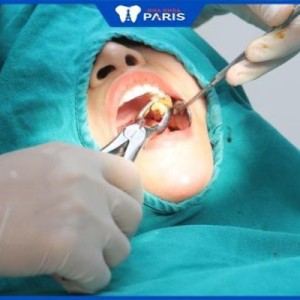Hé lộ TOP 5 bác sĩ nhổ răng khôn giỏi ở Hà Nội bạn nên chọn