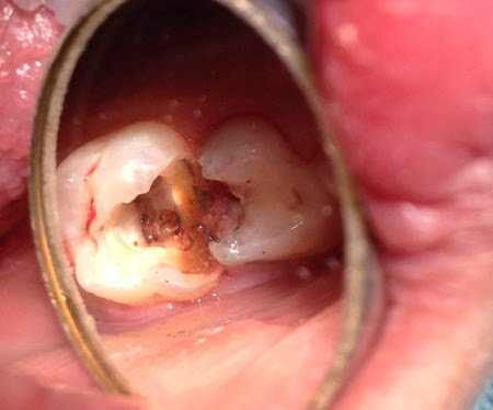 hỗ trợ Điều trị tủy răng an toàn với kính vi phẫu hiện đại 2
