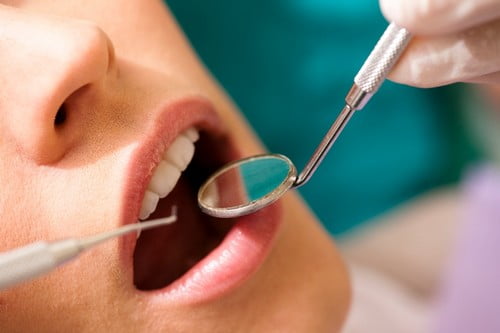 Sâu răng là gì? Cách ngăn ngừa sâu răng