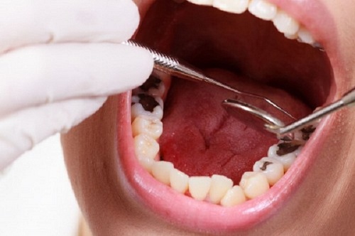  chữa sâu răng uy tín