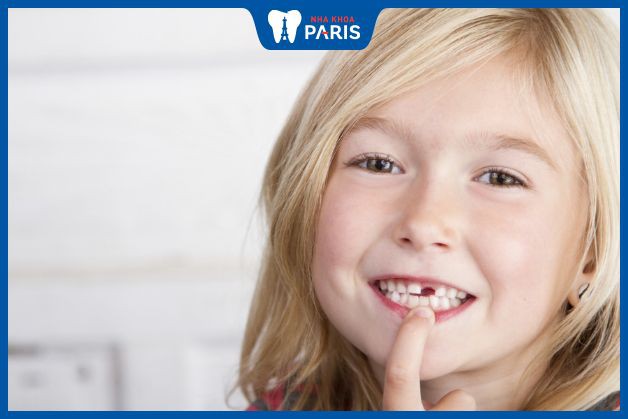 Răng sữa không rụng có thể do không có mầm răng vĩnh viễn