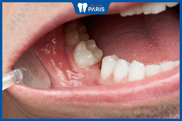 Mất răng lâu năm cần 1 số biện pháp phục hồi hàm trước khi trồng lại