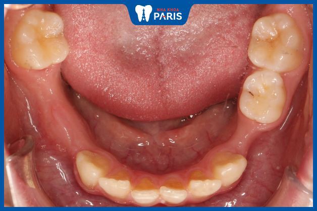 Mất răng lâu ngày gây tiêu xương hàm, chèn ép răng và khó để trồng lại