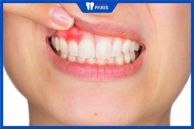 Thiếu răng dễ bị mắc bệnh lý răng miệng