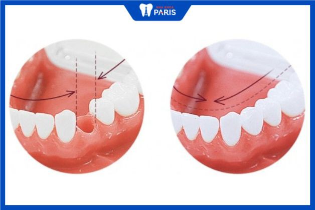 Bị thiếu răng hoặc mất răng từ nhỏ đều cần được khắc phục đảm bảo
