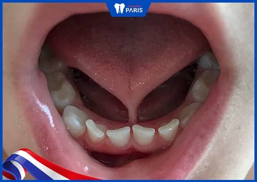 răng thưa ở trẻ do dây nối lưỡi phát triển
