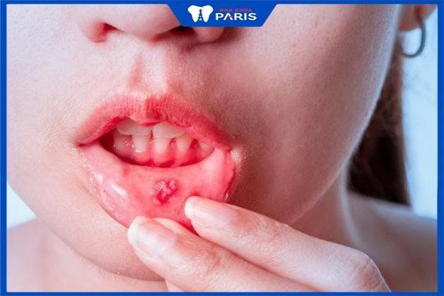 Bệnh cam miệng ở trẻ nhỏ là gì? 