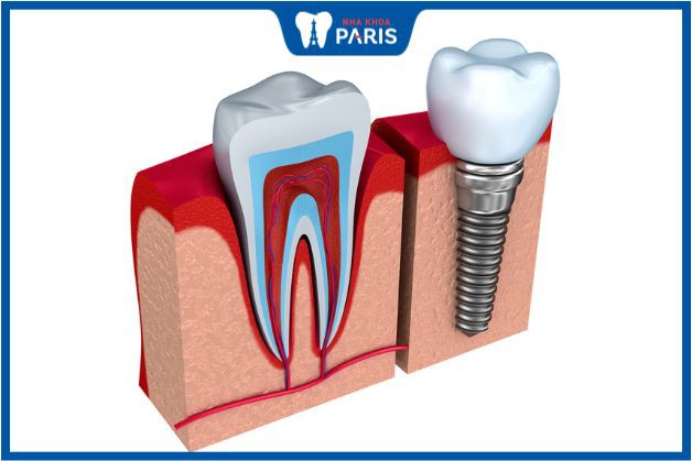 Implant là thay thế răng thật bằng răng nhân tạo