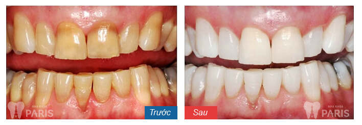 Riview địa chỉ nha khoa uy tín tại Hà Nội - Vĩnh biệt răng xấu 6