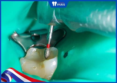 quy trình diệt tủy răng - mở ống tủy