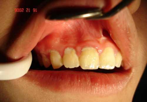 Viêm nướu chân răng gây nguy hiểm và biến chứng gì?
