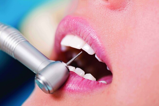 Bọc răng sứ có tốt không? Cách phòng tránh tác hại Triệt Để nhất 3
