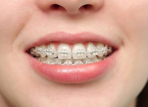 Thời gian niềng răng vẩu phụ thuộc vào yếu tố nào? [BS tư vấn] 1
