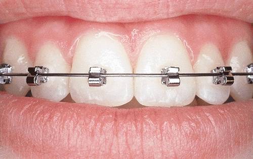 Thời gian niềng răng vẩu phụ thuộc vào yếu tố nào? [BS tư vấn] 4