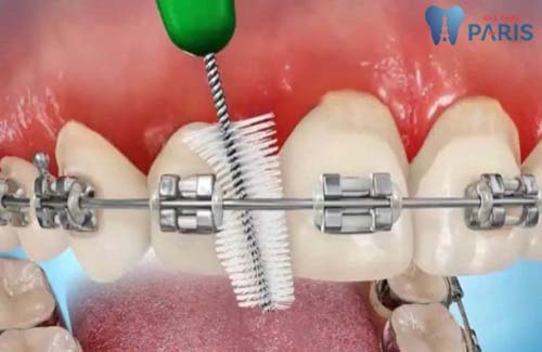 Nhức răng khi niềng: Nguyên nhân & cách khắc phục Vĩnh Viễn 3