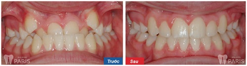 Nhức răng khi niềng: Nguyên nhân & cách khắc phục Vĩnh Viễn 4