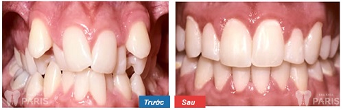 Nhức răng khi niềng: Nguyên nhân & cách khắc phục Vĩnh Viễn 5