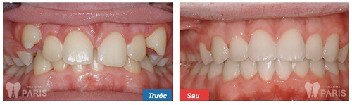 Nhức răng khi niềng: Nguyên nhân & cách khắc phục Vĩnh Viễn 6