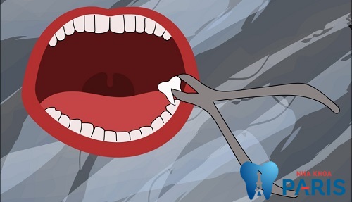 Cách nhổ răng khôn nhanh chóng "KHÔNG ĐAU" không Biến Chứng 5