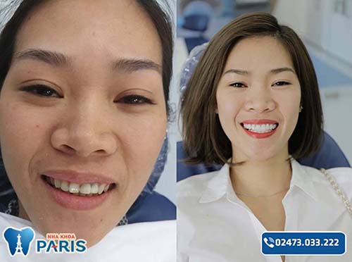 Điều trị răng tại nha khoa Paris có đau không 2
