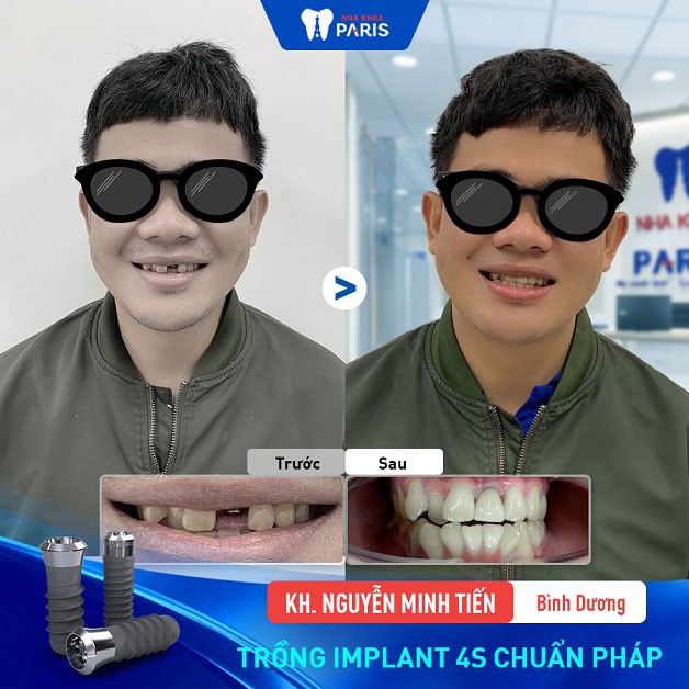 Răng implant rất khó phân biệt với răng thật