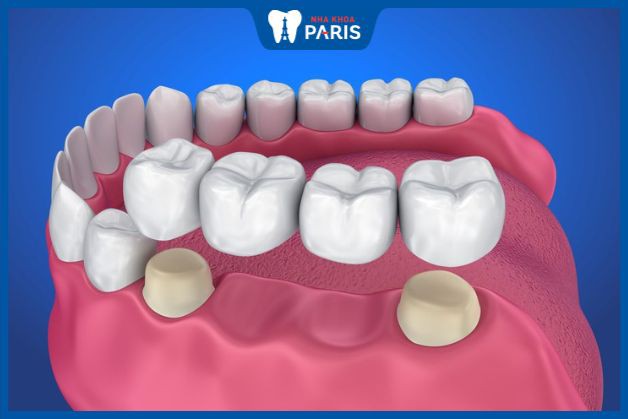 Trồng răng giả có đau không - Cầu răng sứ chỉ hơi ê buốt khi mài răng