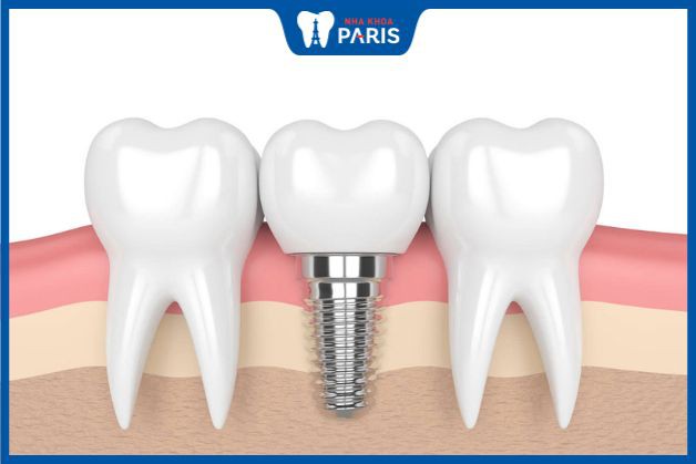 Trồng răng giả có đau không - Trồng implant đau chủ yếu sau khi hết thuốc tê