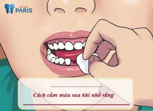 Cách cầm máu sau khi nhổ răng Tại Nhà hiệu quả chỉ sau 10 phút