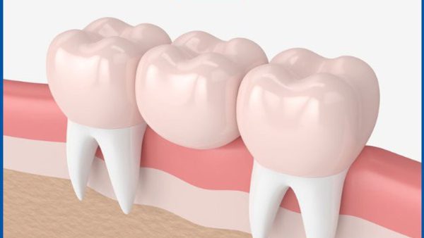 Nhược điểm của Cầu răng sứ là gì? Nên làm cầu răng hay Implant?