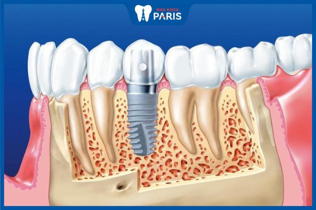 Phương pháp trồng răng bằng Implant