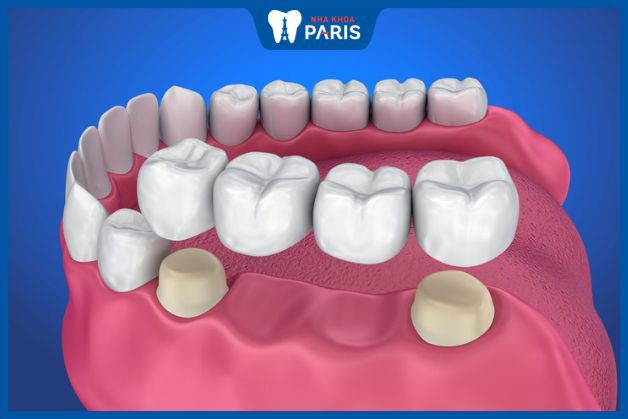 Trồng răng sứ là một trong những phương pháp phục hình răng phổ biến