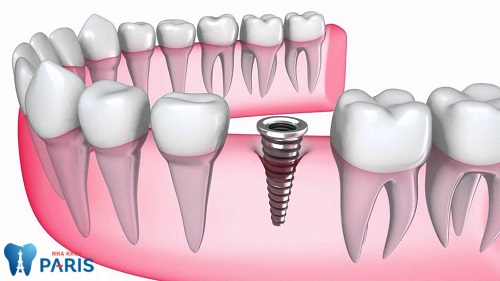 Phương pháp trồng răng bằng Implant