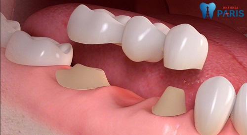 Trồng răng sứ là một trong những phương pháp phục hình răng phổ biến