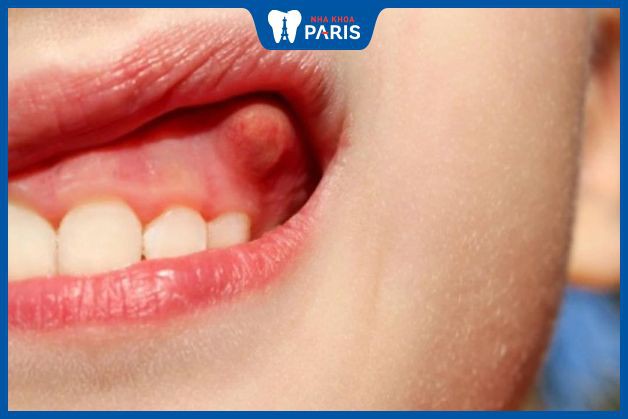 Áp xe răng là biến chứng nguy hiểm của  sâu răng