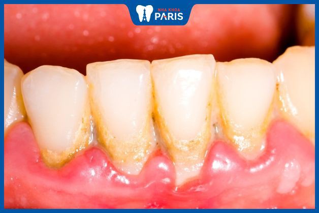 Cao răng là những mảng bám tích tụ lâu ngày trên răng