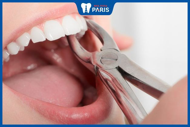 Quá trình nhổ răng sẽ liền thương nhanh nếu được thực hiện tại Nha khoa Paris