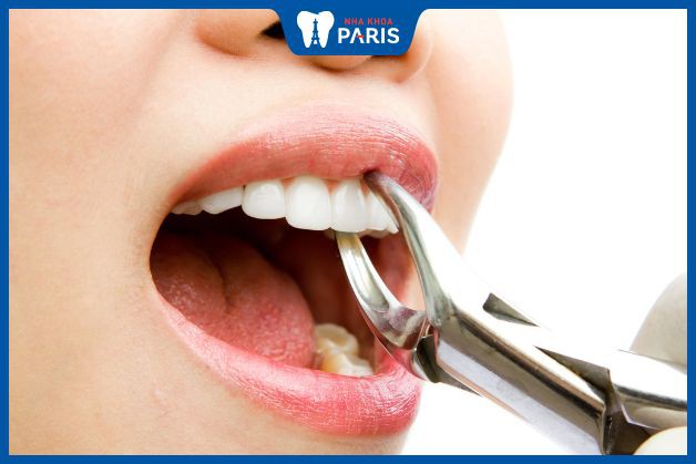 Nhổ răng không ảnh hưởng đến sức khỏe nếu lựa chọn địa chỉ nha khoa uy tín