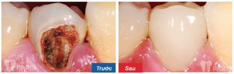 Khách hàng trám răng thẩm mỹ Laser Tech điều trị sâu răng tại Nha khoa Paris.